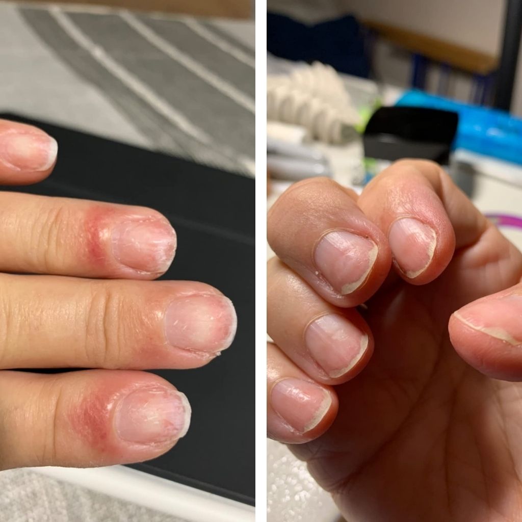 TruviRenew® Nail Aftercare Patches
