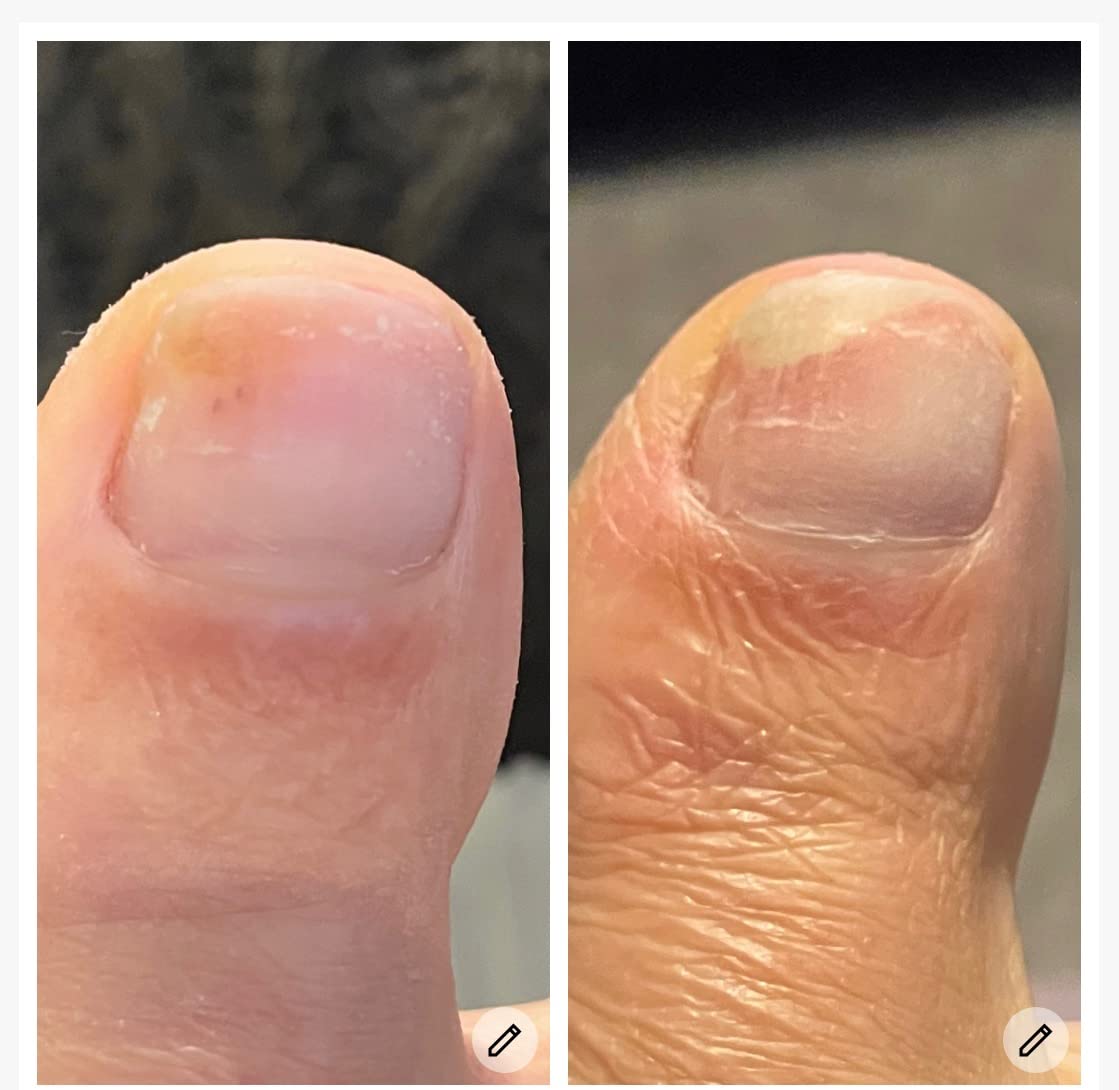 TruviRenew® Nail Aftercare Patches